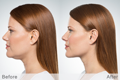 Kybella Facial Fat Reduction Treatment Before and After at White Mountain Med Spa & Ketamine Center in Plymouth NH 