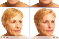 Silhouette Non-Surgical Facelift Treatment Before and After at White Mountain Med Spa & Ketamine Center in Plymouth NH 