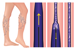 Image of Sclerotherapy for spider vein treatment at White Mountain Med Spa & Ketamine Center in Plymouth NH