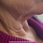 White Mountain Med Spa patient shown before reduction in excess sagging skin on her neck.