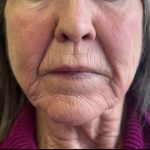 Patient shown before triLift Laser facelift combined with PDO thread lift and liquid face lift.