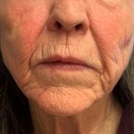 Patient shown after triLift Laser facelift combined with PDO thread lift and liquid face lift.