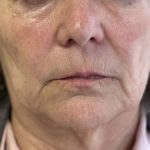 White Mountain Med Spa patient shown before triLift laser non-surgical facelift combined with our non-surgical liquid facelift.