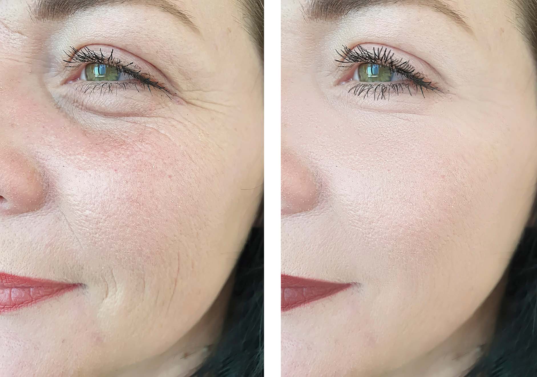 Before and after picture of beautiful middle-aged woman depicting White Mountain Med Spa triLift™ treatment.