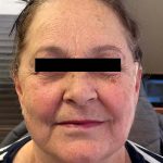 Patient of White Mountain Med Spa in Plymouth NH shown after non-surgical PDO thread lift, facial rejuvenation, facial contouring, jowl reduction, wrinkle reduction, sagging reduction.