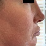 For this patient, we used multi modal techniques, giving her the improved appearance and confidence she was looking for.