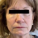 White Mountain Med Spa patient shown before triLift laser facelift.
