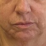 Patient front view. In this before image, the patient has very little definition in her face and jaw line. She was hoping that more definition would help her look and feel younger.