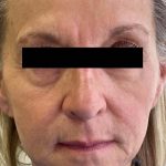 White Mountain Med Spa patient shown before triLift laser treatment non-surgical facelift.
