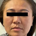 Patient of White Mount Med Spa in Plymouth NH shown before facial rejuvenation, dermal fillers, PDO thread lift and non-surgical liquid facelift.