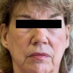 White Mountain Med Spa patient shown before PDO thread lift non-surgical facelift combined with our non-surgical liquid facelift